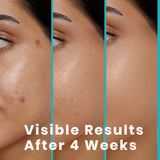 Kojibella✨ - (2 PACK) Jabón despigmentante, antiacné y unificador del tono de la piel